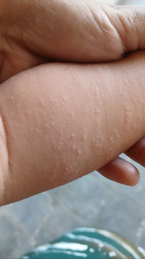 Bintik-bintik pada anak 6 bulan