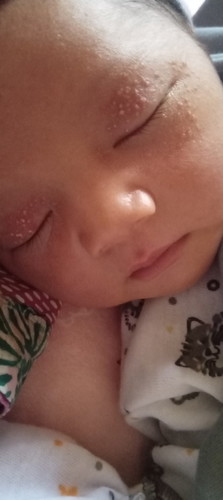 Bun mata merah bernanah itu karena apa yaah? Muncul setelah dua hari lahir