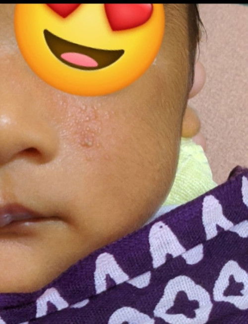 Jerawat kecil-kecil pada bayi