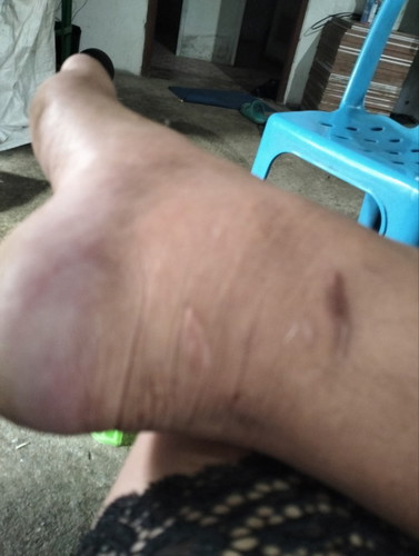 32+1วีคแม่บ้านใหนขาบวฝ่าเท้าสีม่วงแบบนี้บ้างแม่บ้านนี้เดินไม่ไหวเจ้บเท้ามาก😢