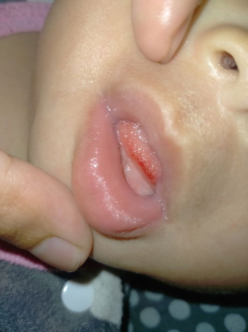 Ujung Lidah bayi merah