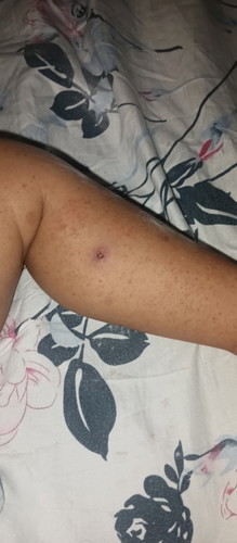 Hello mga mommies may tanong lang po ako ano po kaya itong parang rashes sa baby ko?