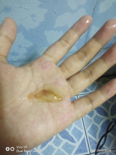 มีมูกไหลออกมา