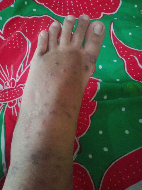 habis sc tgl 21 pulang dari rs makan apapun rasanya gatal panas kulit bentol" kaya gini kenapa ya bu