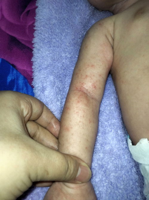 Bintik merah di tangan dan muka