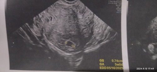 No Yolk Sac / fetal Pole