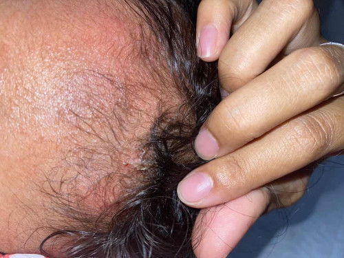 Bun apa ya penyebab bonongan (benjolan merah di kepala beberapa lama menjadi seperti nanah) pd anak?