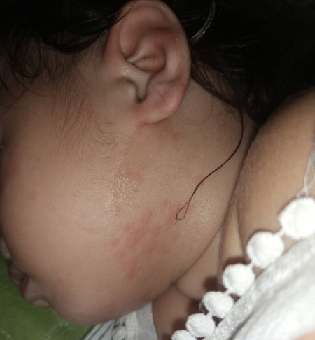 Ano po gamot para dito ? di ko napo alam kung anong gagawin kasi first time mom lang ako .