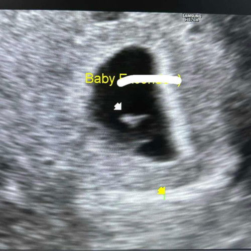 Irregular shaped gestational sac