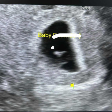 Irregular shaped gestational sac