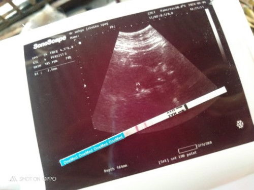 Bun hamil 5-6minggu d'usg masih terlihat kecil.. Kiraa² itu kantong / janin??