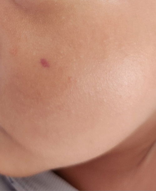 Purplish spot appeared on LO face overnight, help!