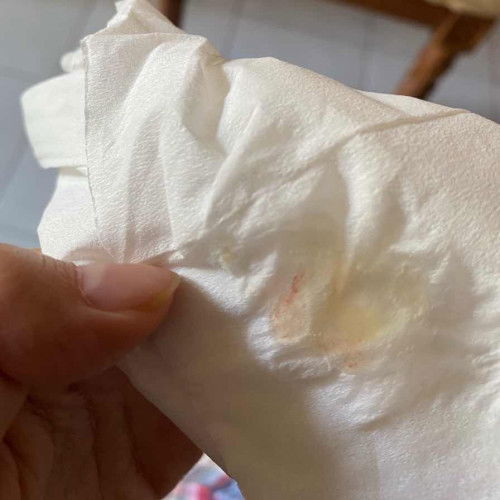 Masuk TM 2 Batuk Berdahak ada bercak Darahnya