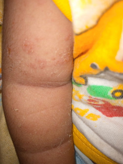 Bintik bintik pada kulit bayi