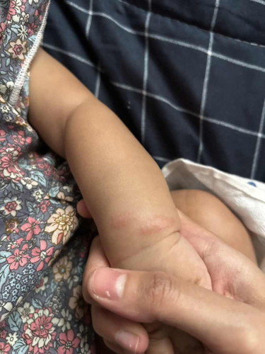 kena gigit nyamuk ke semut ni?