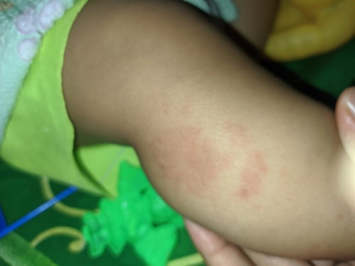 Merah" pada kaki bayi