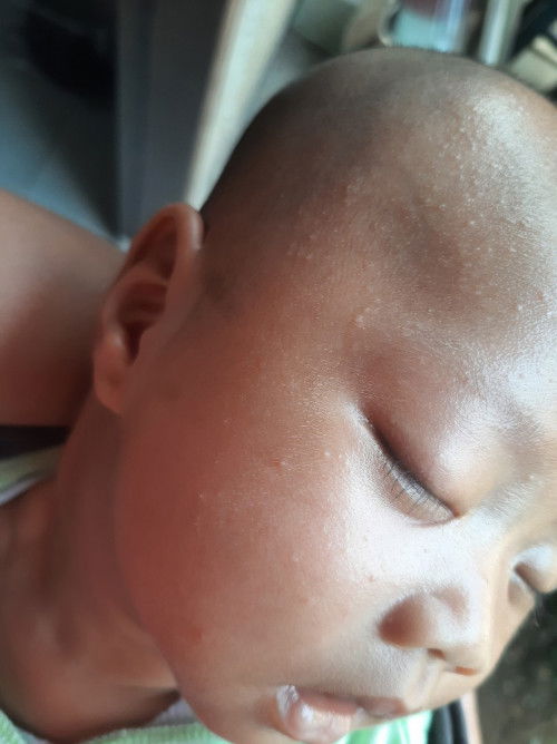 Bruntusan muka si bayi