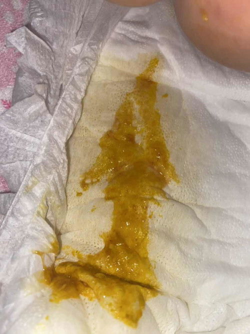 Blood streaks sa poopoo #5mos old baby