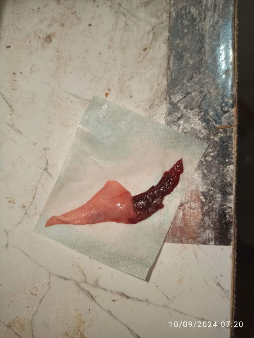 Keluar daging seperti kulit ayam saat haid