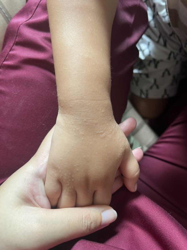 ลูกมีตุ่มที่มือค่ะ