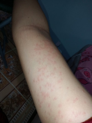 แม่เคยเป็นผื่นแดงๆขึ้นแบบนี้ไหมคะ
