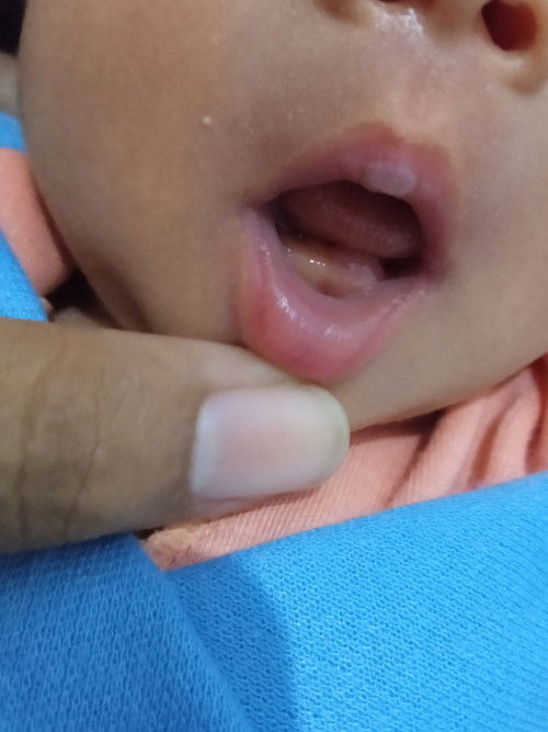 Benjolan di gusi bayi