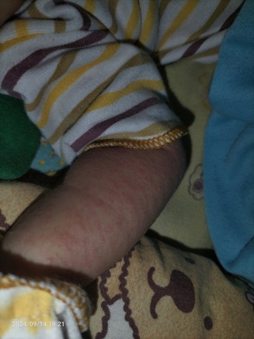 Bintik merah/ruam pada bayi
