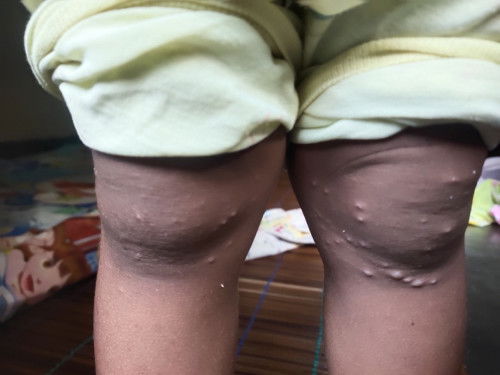 Obat cacar air pada balita