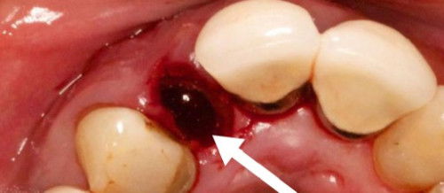 AFTER TOOTH EXTRACTION