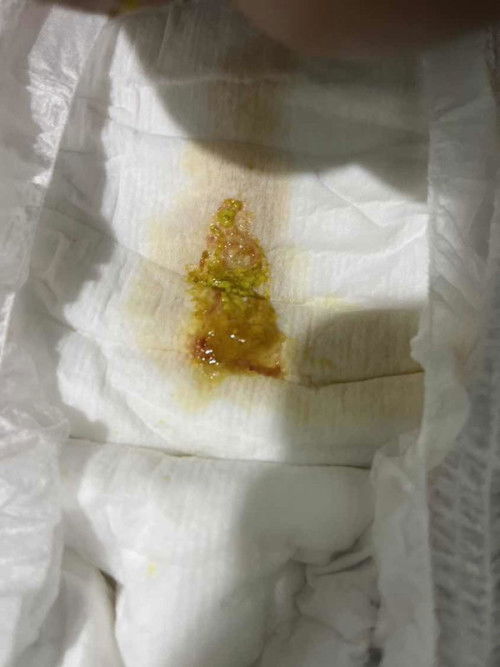 ลูก2เดือน  นมแม่ล้วน อึไม่ค่อยบ่อยแล้วอยู่ๆเมื่อคืนเริ่มอึบ่อยเหมือนตอนแรกเกิดอีก