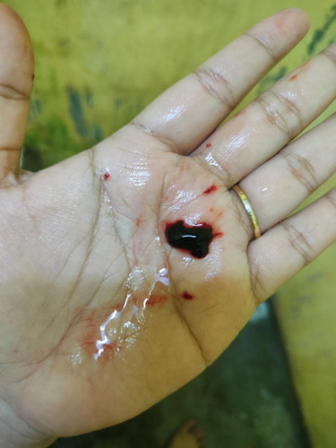 Upt positif 12/13 hb . Dah masuk 4 week , tapi tiba² keluar darah tanpa rasa sakit .