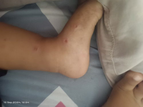 Gatel di bagian kaki