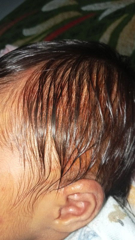 kepala bayi 22 hari berkerak dan ruam merah