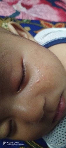 Biji2 kecil dimuka baby