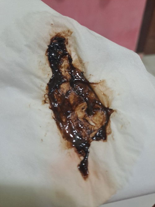 Flek seperti selaput