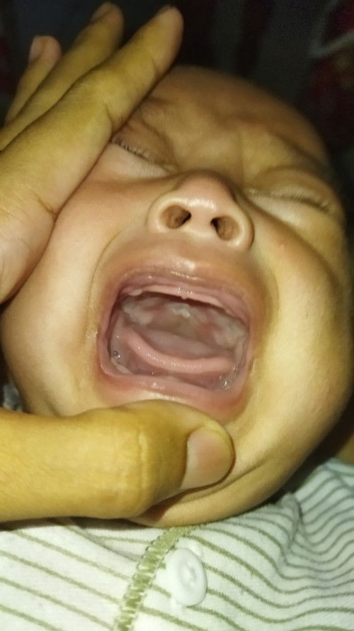 Sariawan di mulut bayi