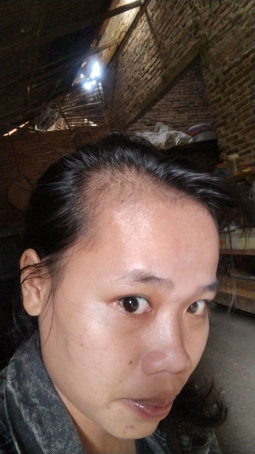 rambut rontok ibu menyusui
