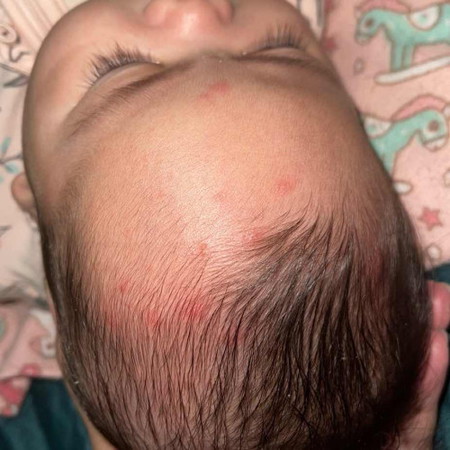 Biji merah2 di kepala baby