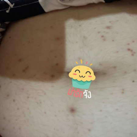 แม่ๆคนไหนสิวขึ้นหน้าท้องบ้างคะ