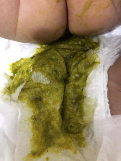 Rambut Rontok dan BAB hijau