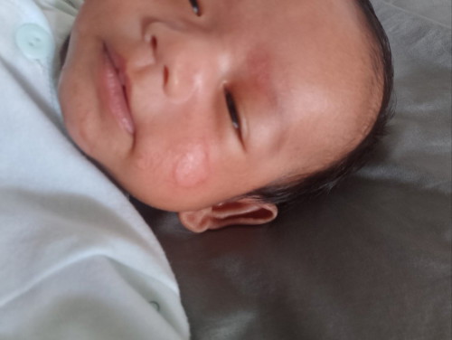 Ni ruam susu ke ?