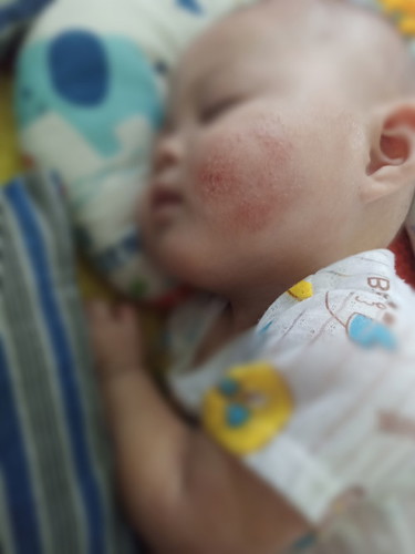 Mommy bole x share pglmn ank ada eczema