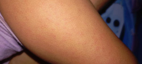 Ruam kecil-kecil di badan anak