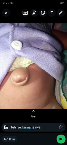Pusar bayi menonjol