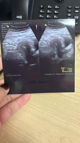 CYST ATAU BABY DALAM RAHIM