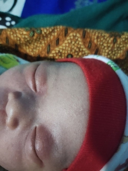 mata bengkak pada bayi