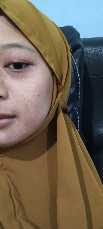 wajah meradang pasca persalinan