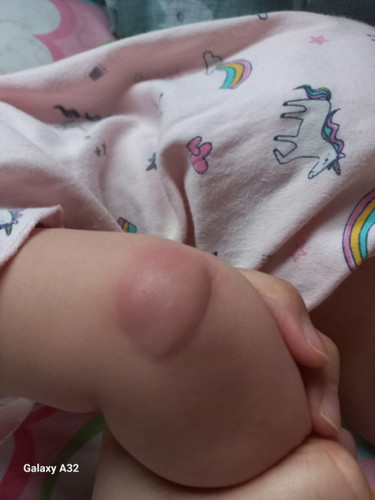 Ada kesan timbul pada baby