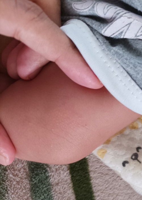 Bintik pada kulit bayi