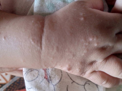 Obat salep gatal buat baby